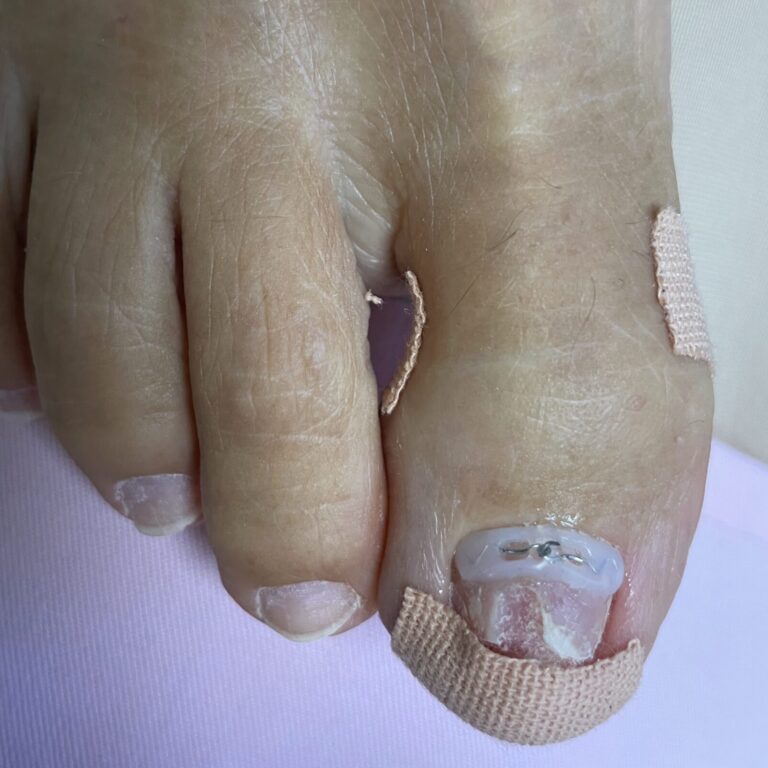 Nehtové rovnátko Podofix - salon Gabriela Salichova