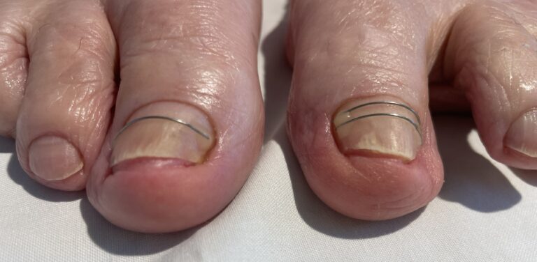 Nehtové rovnátko NiTi titanová nit - pedikúra Gabriela Salichová Opava