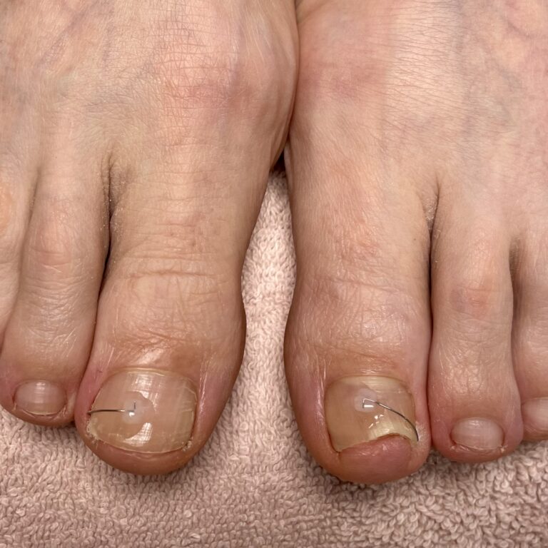 Nehtové rovnátko CombiPed - salon Gabriela Salichova