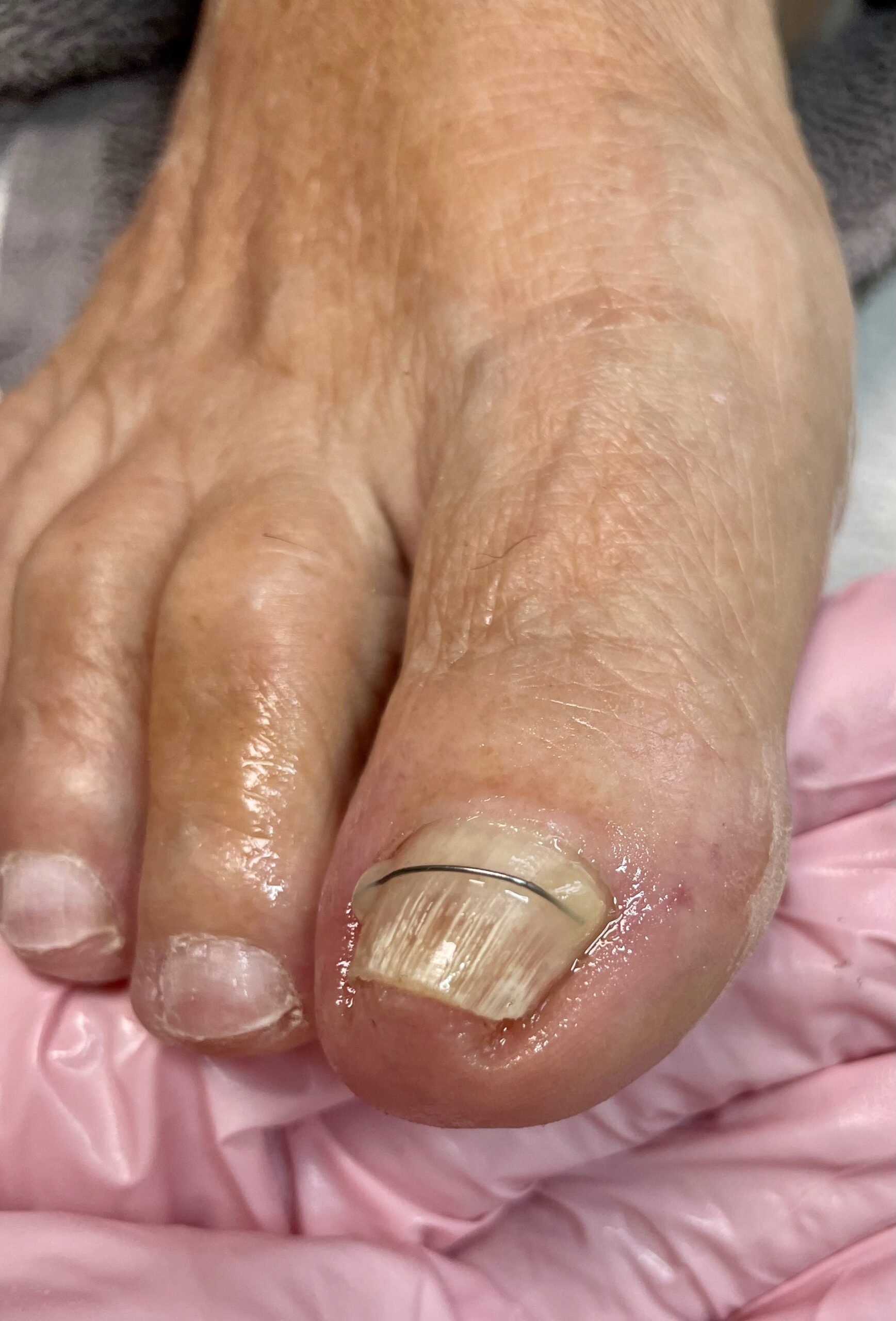 Nehtove rovnatko titanova nit NiTi