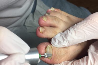 Snižování ztluštělého nehtu Pedikúra Gabriela